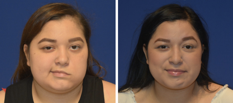 Bells Palsy Before and After in Los Angeles