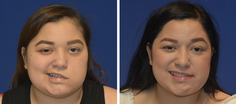 Bells Palsy Before and After in Los Angeles