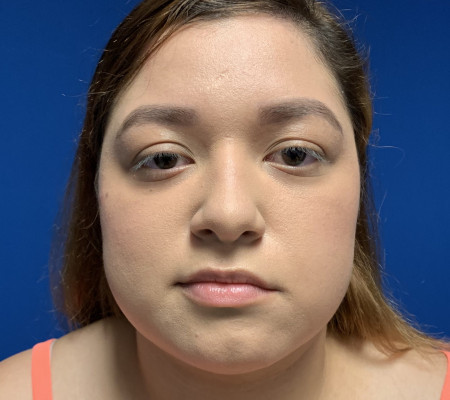 Facial Paralysis after photo. Individual results may vary.