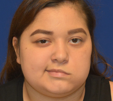 Facial Paralysis before photo. Individual results may vary.