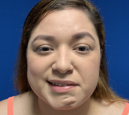 Facial Paralysis after photo. Individual results may vary.