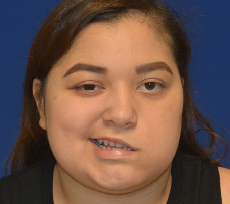 Facial Paralysis before photo. Individual results may vary.